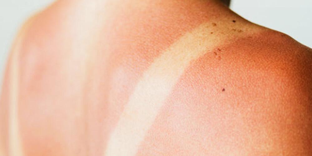 Leégett bőr kezelése