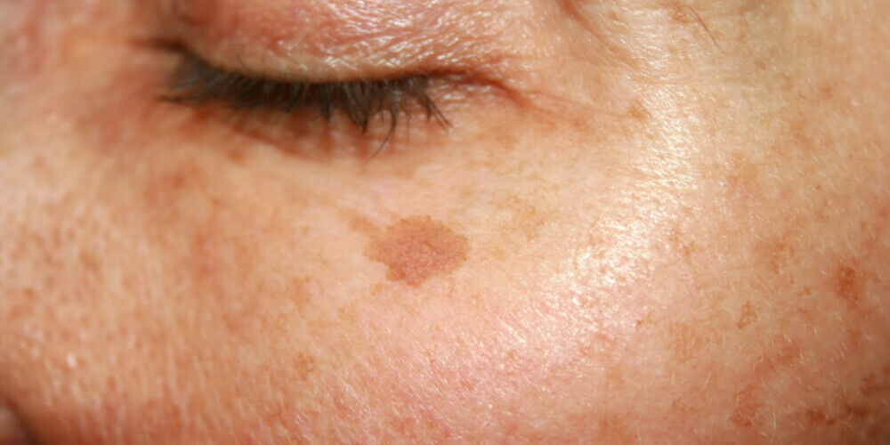 A bőr korai öregedésének jelei