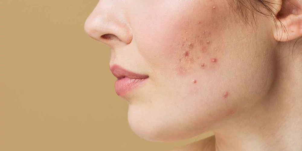 Pattanásos bőr kezelése - Minden, amit tudnod kell a pattanásokról